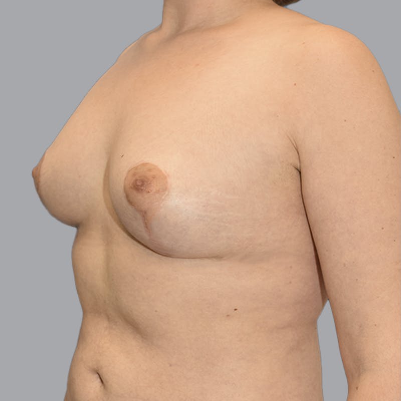 Breast Lift Before & After Gallery - Patient 197842 - Image 6