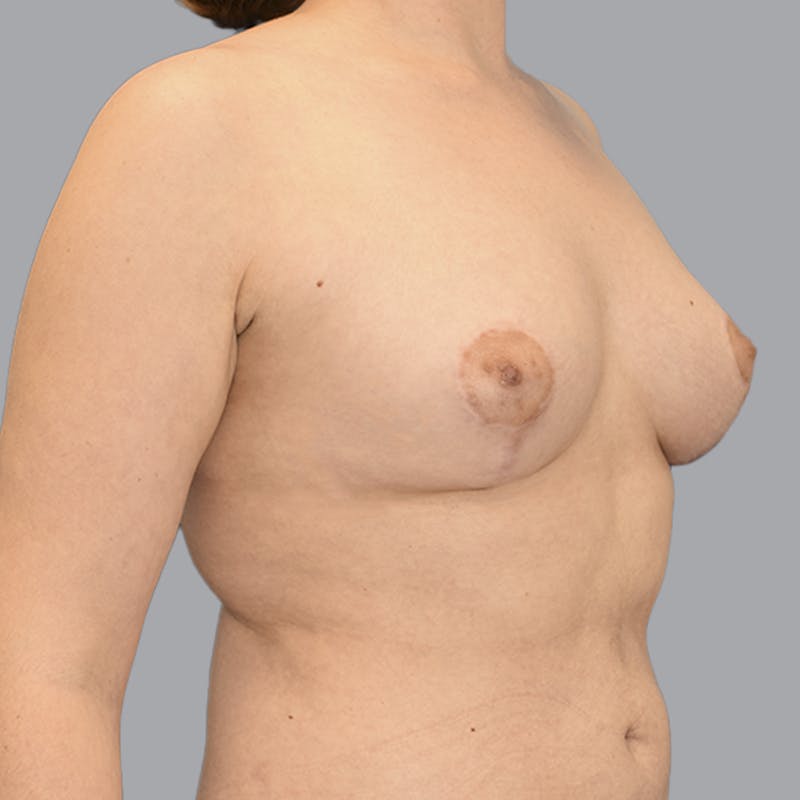 Breast Augmentation with Fat Transfer Before & After Gallery - Patient 149691 - Image 4