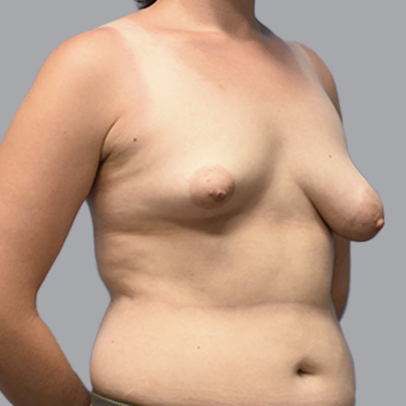 Breast Lift Before & After Gallery - Patient 197842 - Image 3
