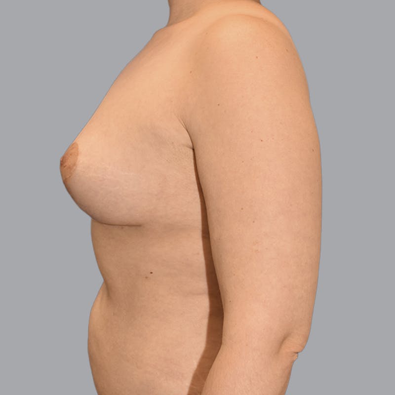 Breast Augmentation with Fat Transfer Before & After Gallery - Patient 149691 - Image 8