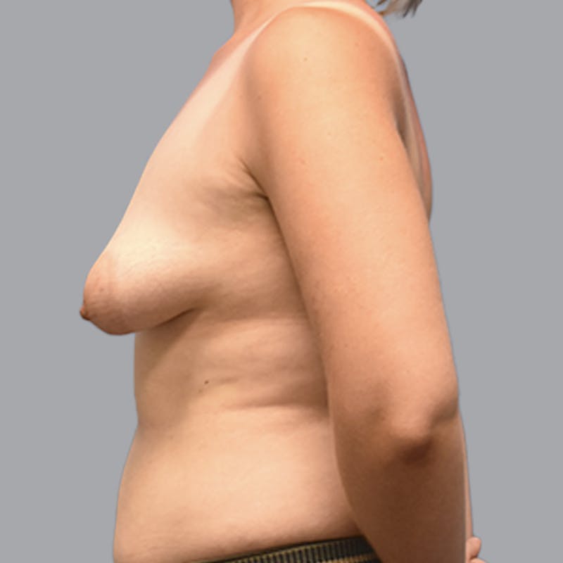 Breast Augmentation with Fat Transfer Before & After Gallery - Patient 149691 - Image 7