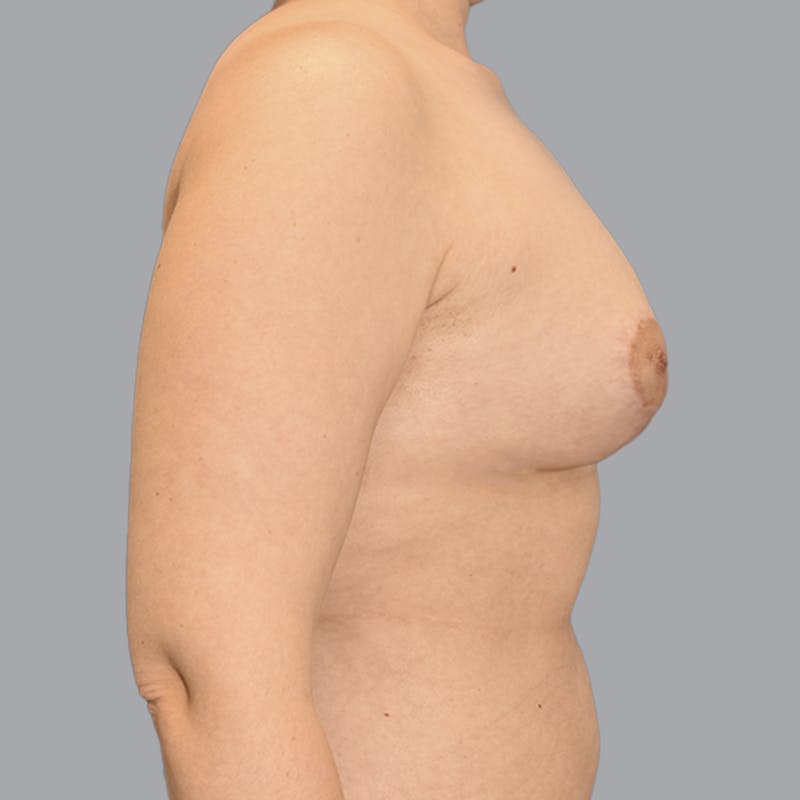 Breast Augmentation with Fat Transfer Before & After Gallery - Patient 149691 - Image 10