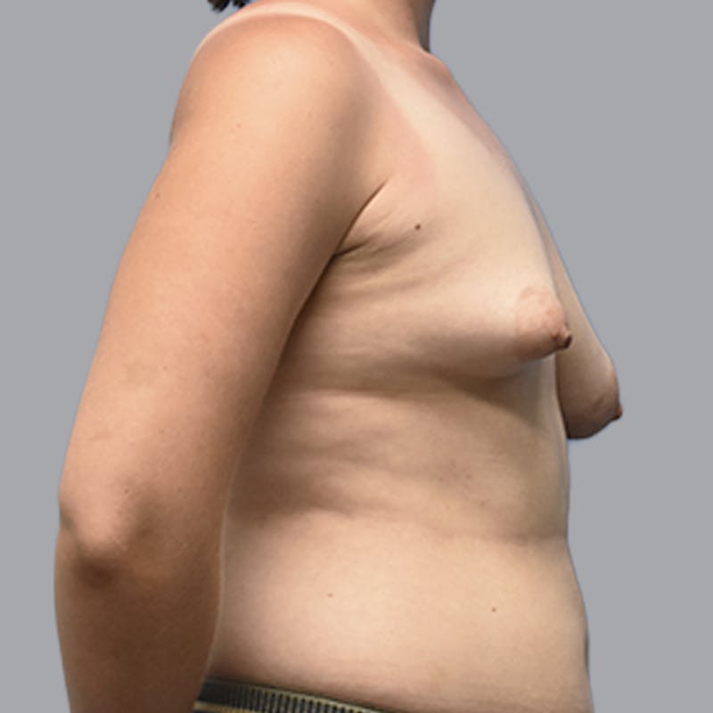 Breast Augmentation with Fat Transfer Before & After Gallery - Patient 149691 - Image 9