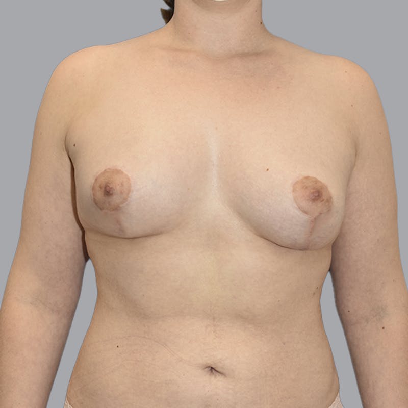 Breast Augmentation with Fat Transfer Before & After Gallery - Patient 149691 - Image 2