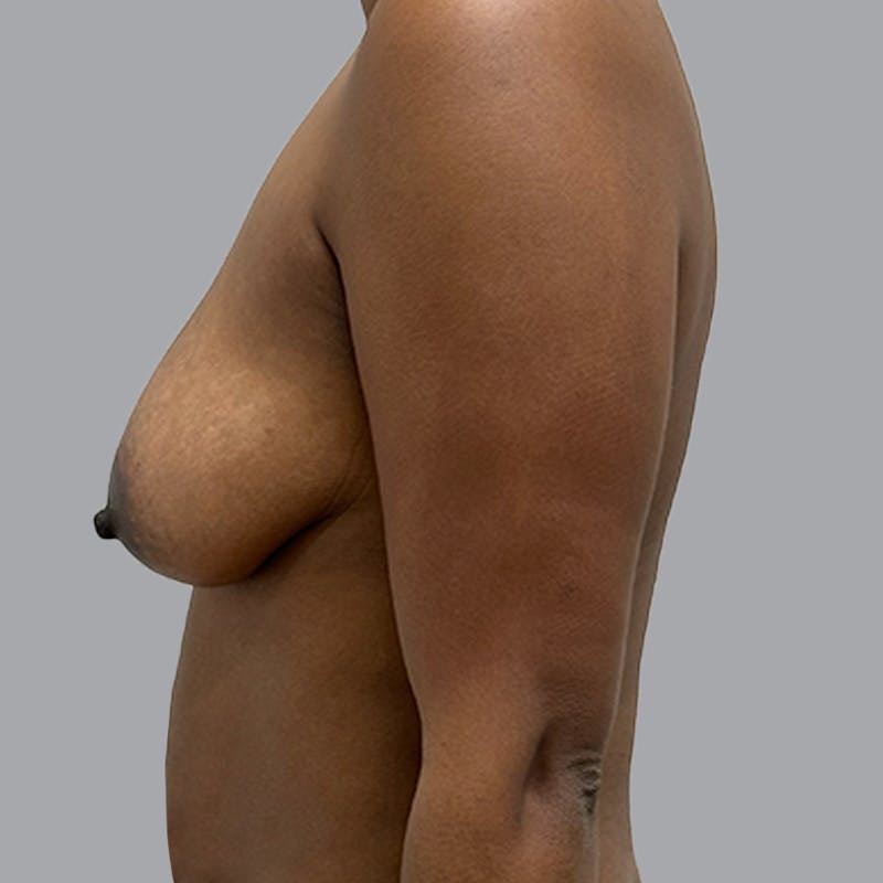 Breast Augmentation with Fat Transfer Before & After Gallery - Patient 186139 - Image 6