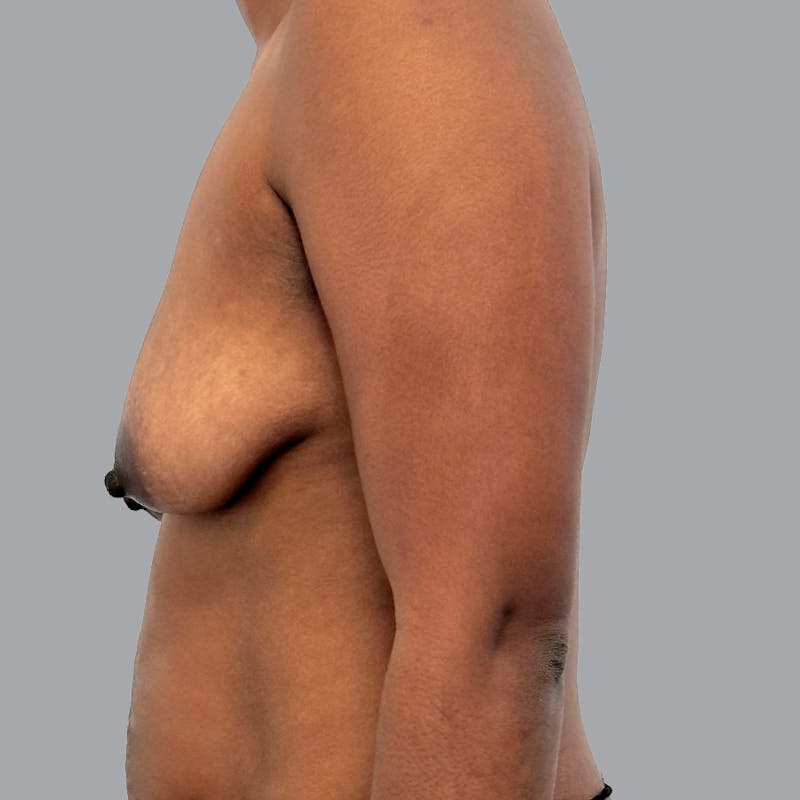 Breast Augmentation with Fat Transfer Before & After Gallery - Patient 186139 - Image 5