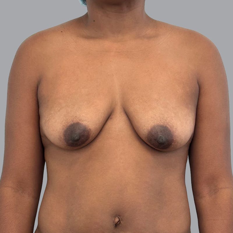 Breast Augmentation with Fat Transfer Before & After Gallery - Patient 186139 - Image 1
