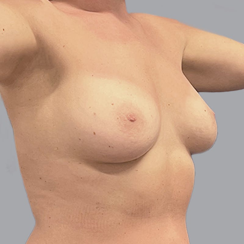 Breast Augmentation with Fat Transfer Before & After Gallery - Patient 205974 - Image 4