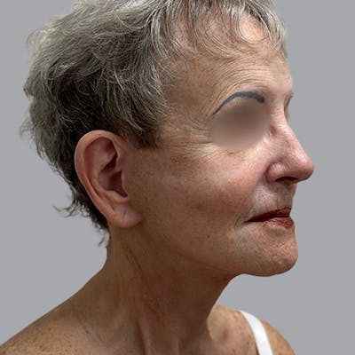 Facelift and Neck Lift Before & After Gallery - Patient 412286 - Image 4