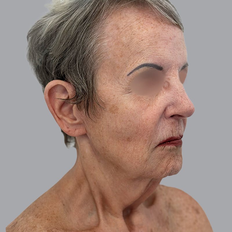 Facelift and Neck Lift Before & After Gallery - Patient 412286 - Image 3