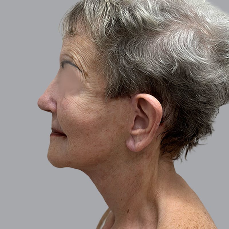 Facelift and Neck Lift Before & After Gallery - Patient 412286 - Image 2