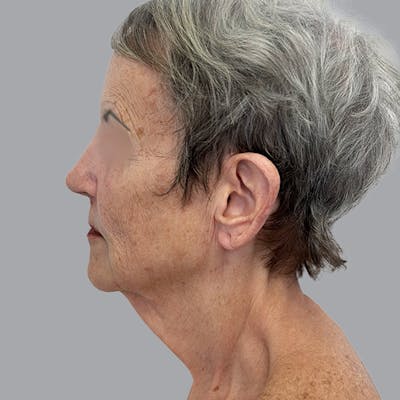 Facelift and Neck Lift Before & After Gallery - Patient 412286 - Image 1