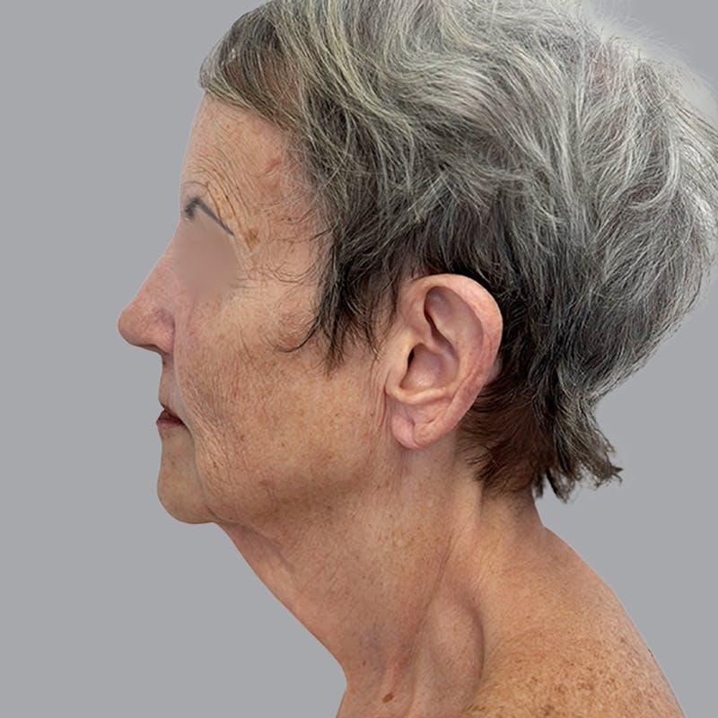 Facelift and Neck Lift Before & After Gallery - Patient 412286 - Image 1