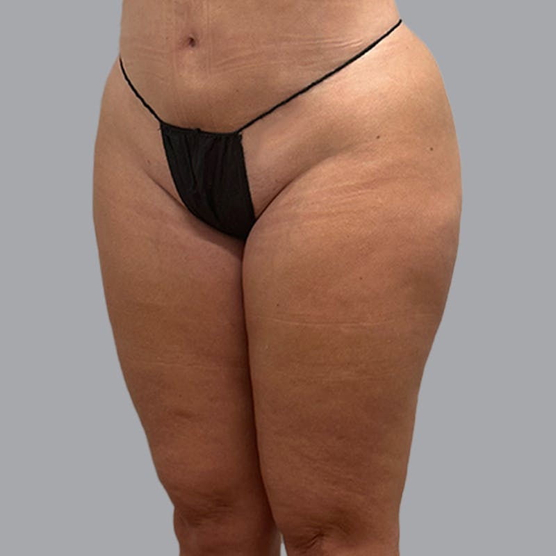Brazilian Butt Lift and Hip Dip Before & After Gallery - Patient 260226 - Image 4