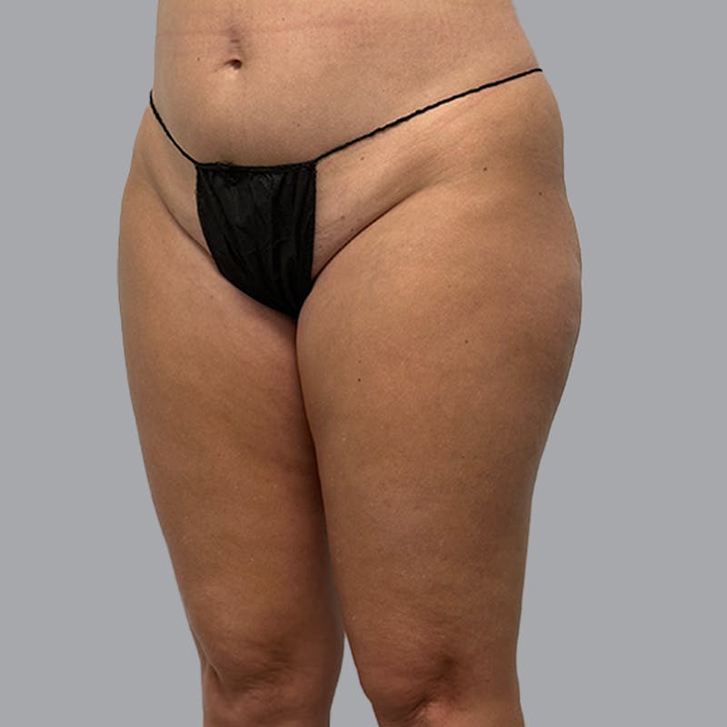 Brazilian Butt Lift and Hip Dip Before & After Gallery - Patient 260226 - Image 3