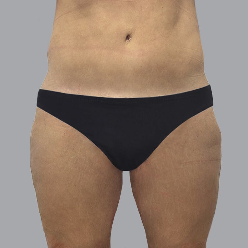 Thigh Lift Before & After Gallery - Patient 189395 - Image 2