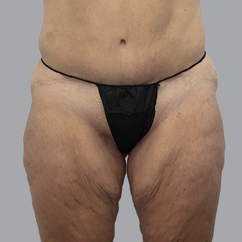 Thigh Lift Before & After Gallery - Patient 189395 - Image 1