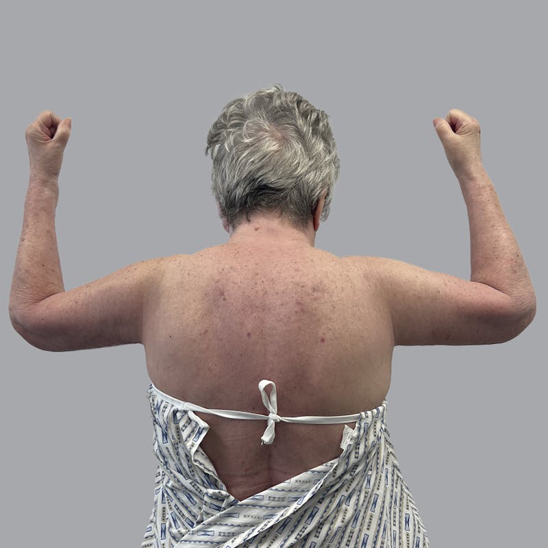 Arm Lift Before & After Gallery - Patient 402288 - Image 2