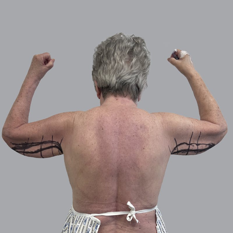 Arm Lift Before & After Gallery - Patient 402288 - Image 1