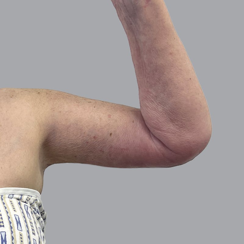 Arm Lift Before & After Gallery - Patient 402288 - Image 4
