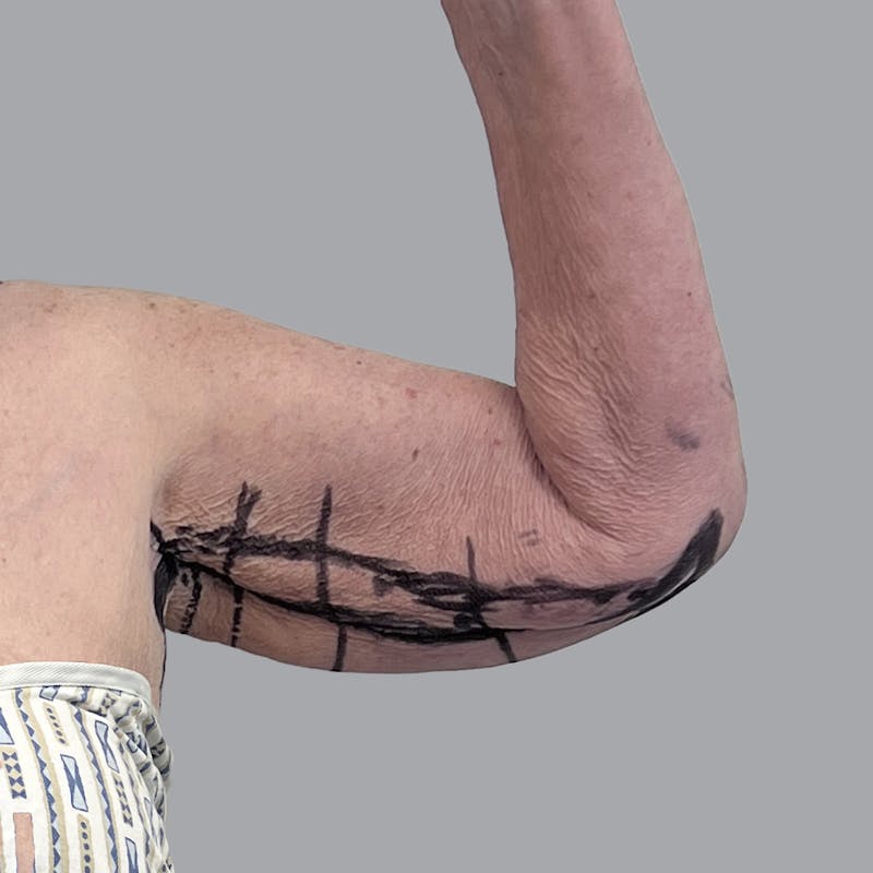 Arm Lift Before & After Gallery - Patient 402288 - Image 3