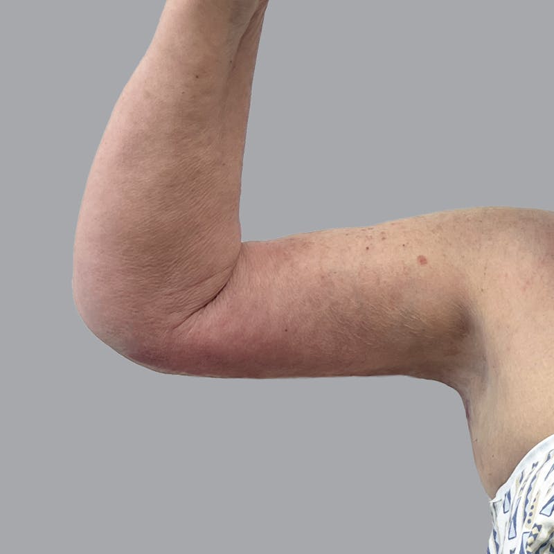 Arm Lift Before & After Gallery - Patient 402288 - Image 6