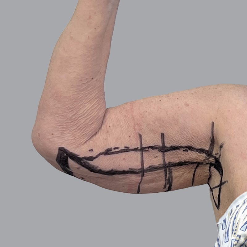Arm Lift Before & After Gallery - Patient 402288 - Image 5