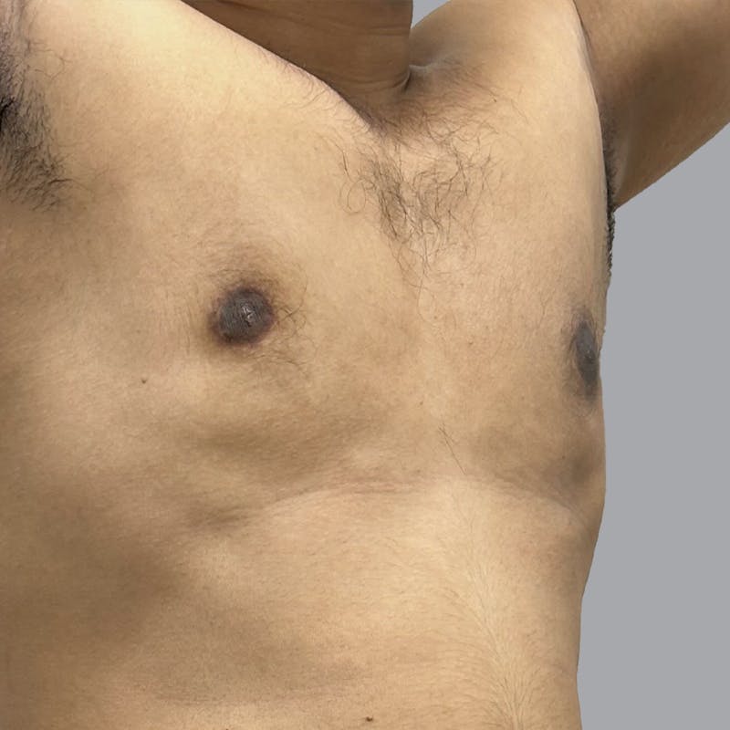 Gynecomastia Before & After Gallery - Patient 158112 - Image 4