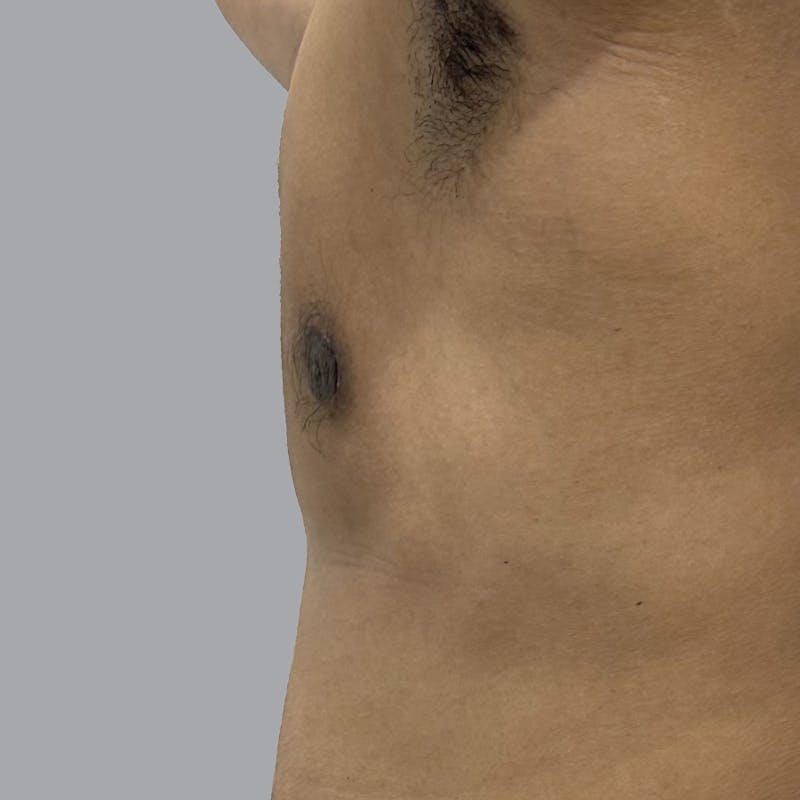 Gynecomastia Before & After Gallery - Patient 158112 - Image 6