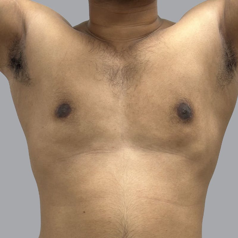 Gynecomastia Before & After Gallery - Patient 158112 - Image 2