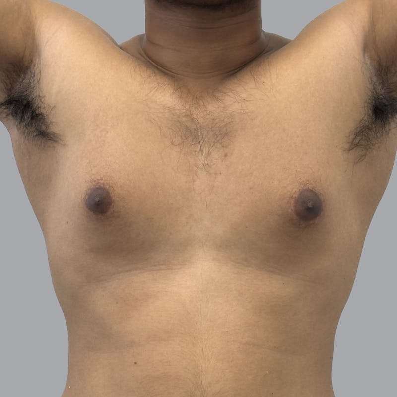 Gynecomastia Before & After Gallery - Patient 158112 - Image 1