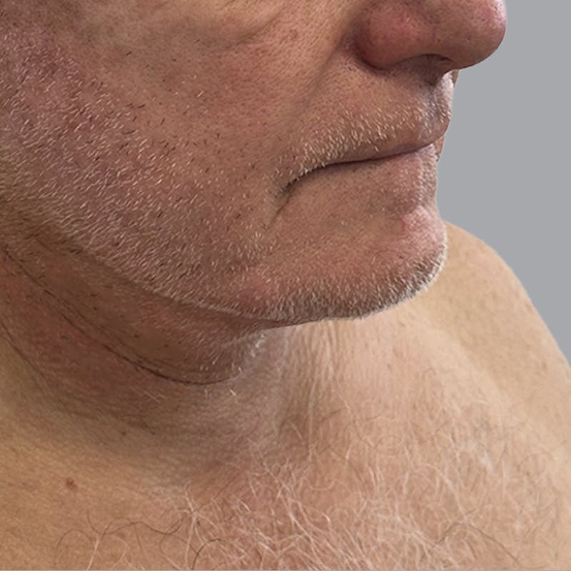 Facelift and Neck Lift Before & After Gallery - Patient 416119 - Image 4