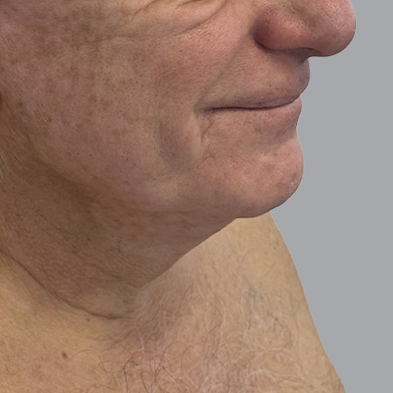 Facelift and Neck Lift Before & After Gallery - Patient 416119 - Image 3