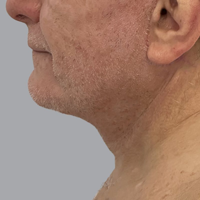 Facelift and Neck Lift Before & After Gallery - Patient 416119 - Image 6