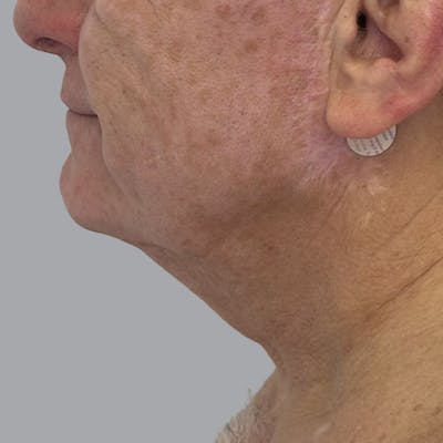 Facelift and Neck Lift Before & After Gallery - Patient 416119 - Image 5