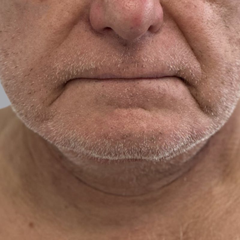 Facelift and Neck Lift Before & After Gallery - Patient 416119 - Image 2