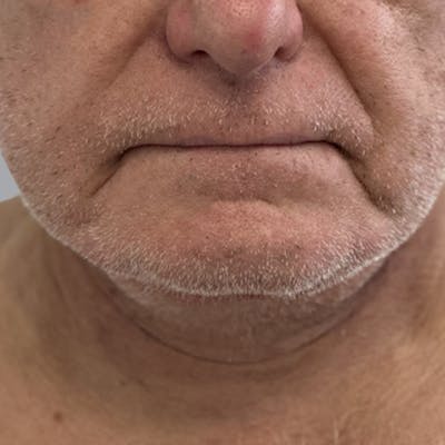 Facelift and Neck Lift Before & After Gallery - Patient 416119 - Image 2