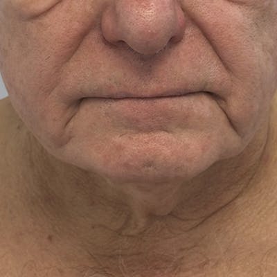 Facelift and Neck Lift Before & After Gallery - Patient 416119 - Image 1