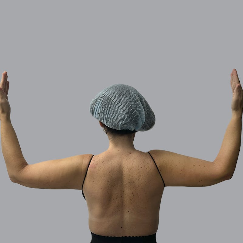 Arm Liposuction Before & After Gallery - Patient 115002 - Image 2