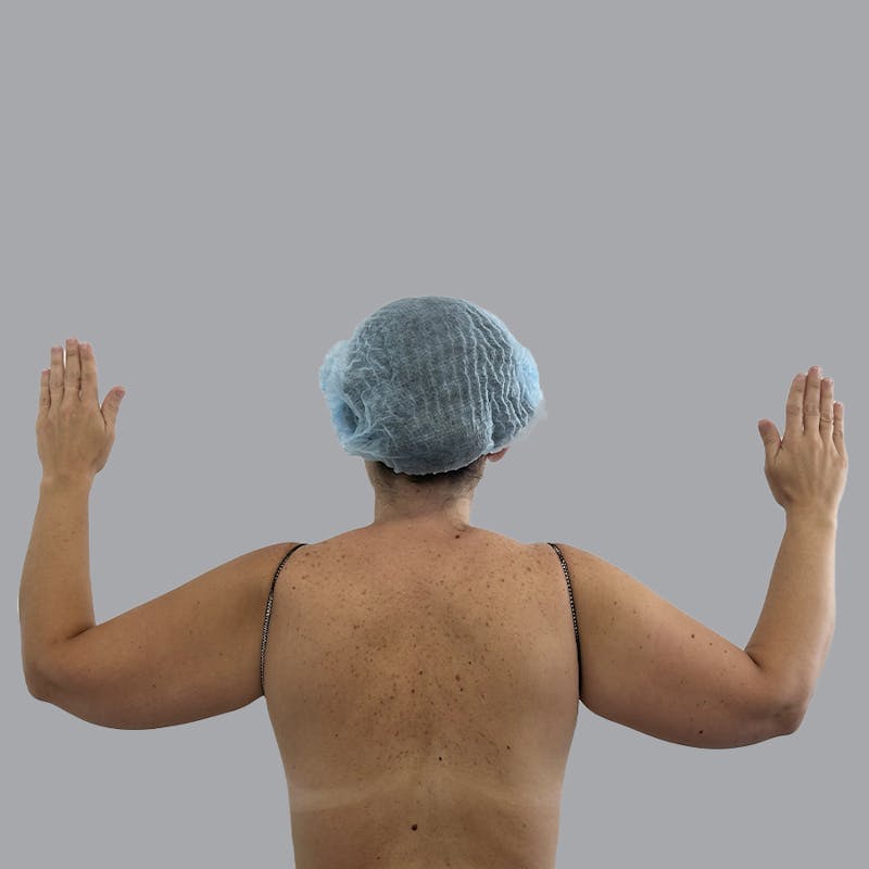 Arm Liposuction Before & After Gallery - Patient 115002 - Image 1