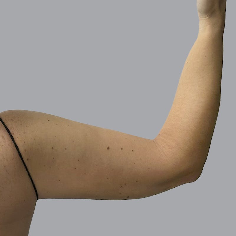 Arm Liposuction Before & After Gallery - Patient 115002 - Image 4