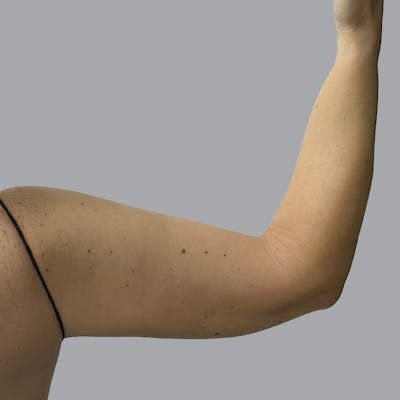 Lipedema Before & After Gallery - Patient 348889 - Image 4