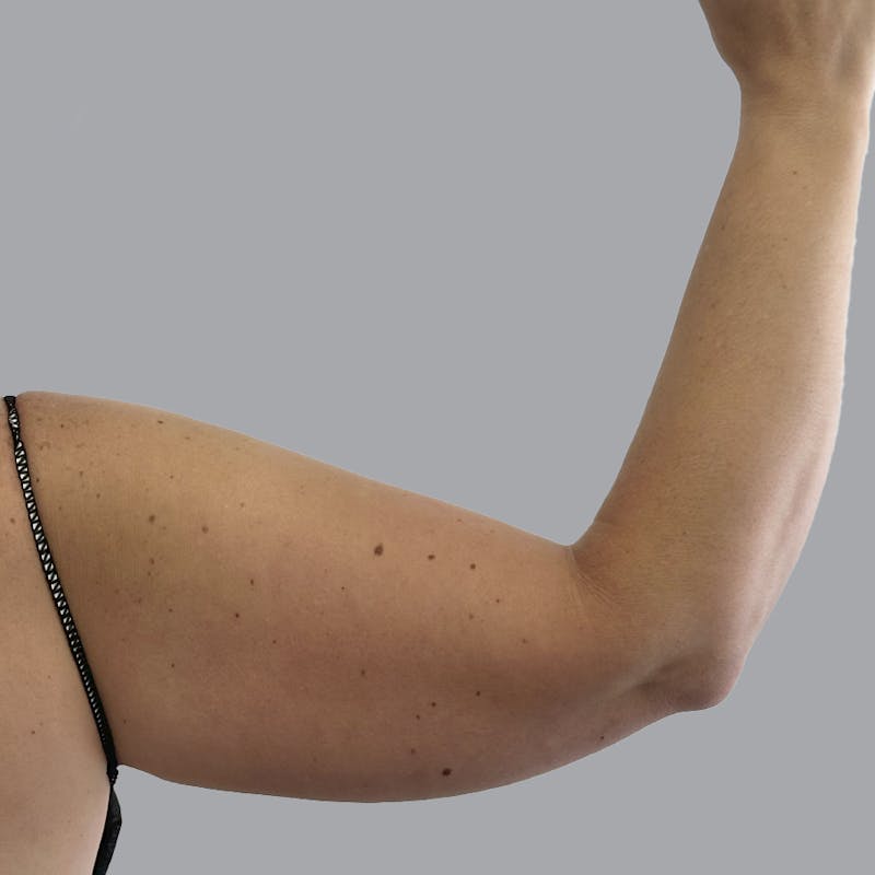 Arm Liposuction Before & After Gallery - Patient 115002 - Image 3