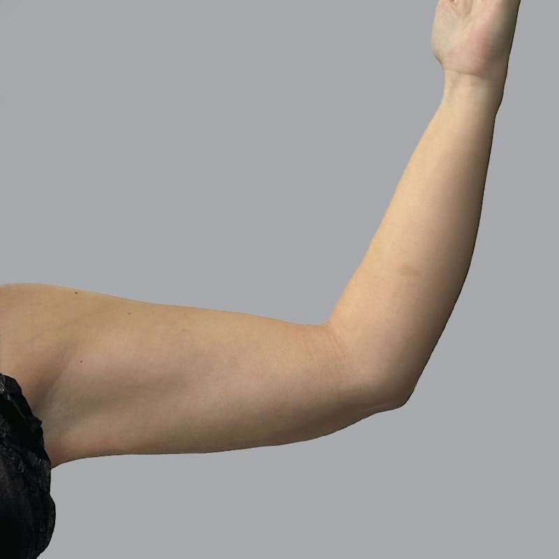 Arm Liposuction Before & After Gallery - Patient 115002 - Image 6