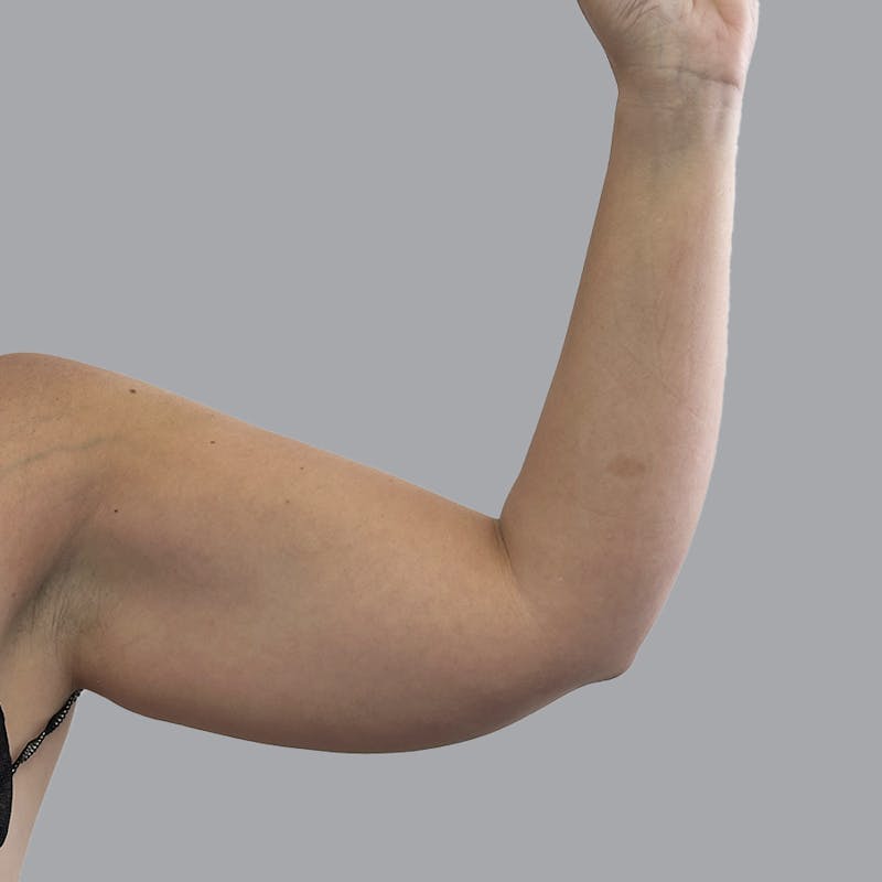 Arm Liposuction Before & After Gallery - Patient 115002 - Image 5