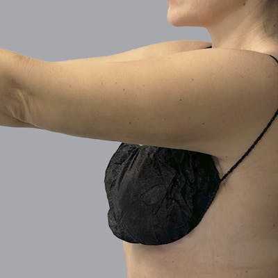 Lipedema Before & After Gallery - Patient 348889 - Image 8