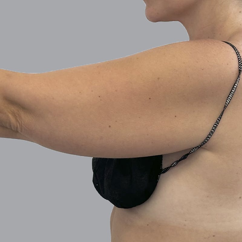 Arm Liposuction Before & After Gallery - Patient 115002 - Image 7