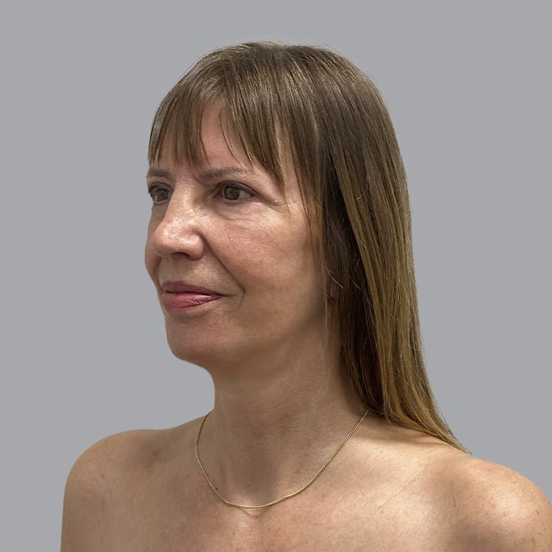Facelift and Neck Lift Before & After Gallery - Patient 389994 - Image 4