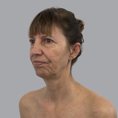 Facelift and Neck Lift Before & After Gallery - Patient 389994 - Image 3