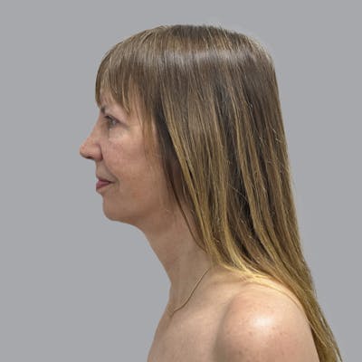 Facelift and Neck Lift Before & After Gallery - Patient 389994 - Image 6